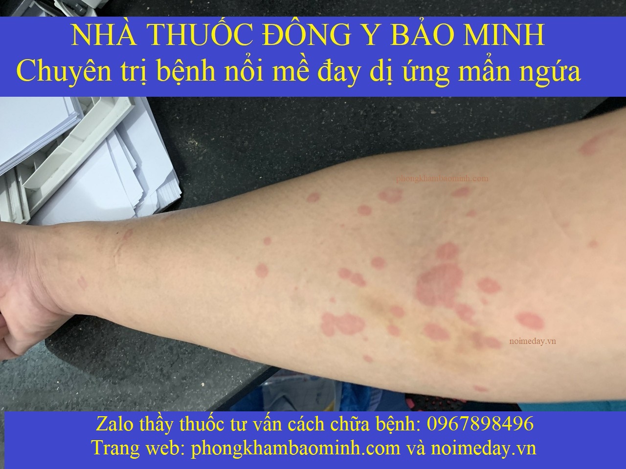 Nổi mề đay kiêng gì